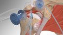 Superior Capsular Reconstruction