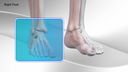 Flatfoot Repair with Calcaneus Step Plate