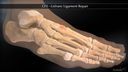 CFS Lisfranc Ligament Repair