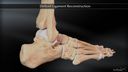 Deltoid Ligament Reconstruction