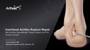 Insertional Achilles Rupture Repair With Achilles SpeedBridge™ Repair System and FHL Tendon Transfer