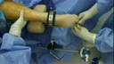 Improved Arthroscopic Access to the Ankle Joint, using the Arthrex Ankle Distractor System