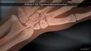 Arthrex CMC Ligament Reconstruction