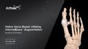 Hallux Varus Repair Utilizing InternalBrace™ Augmentation