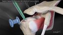 Superior Capsular Reconstruction With ArthroFLEX® Dermal Allograft