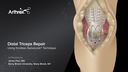 Distal Triceps Repair Using Knotless SwiveLock®