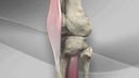 Tibial Tubercle Osteotomy with T3 AMZ System