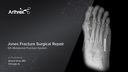 Jones Fracture Surgical Repair 5th Metatarsal Fracture System