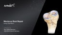 Meniscus Root Repair - Using FiberWire®