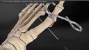 The 1.1 mm Mini TightRope® Implant for Hallux Valgus Correction
