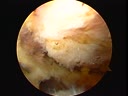 Suture Passing Strategies for Arthroscopic Rotator Cuff Repair