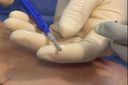 Cross-Link Rotator Cuff Repair Using FiberChain® & SwiveLock® Anchor System