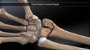 Distal Radius Fracture Repair