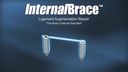 InternalBrace™ Ligament Augmentation Repair - “The Body's Internal Seat Belt”