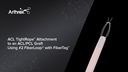 ACL TightRope® Attachment to an ACL/PCL Graft Using #2 FiberLoop® with FiberTag™