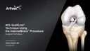 ACL GraftLink® Technique With InternalBrace™ Ligament Augmentation