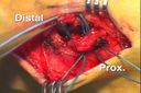 Modified Brostrom Procedure