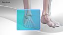 Chronic Ankle Sprain Augmentation Repair with InternalBrace™ Ligament Augmentation Repair