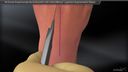All-Dorsal Scapholunate Reconstruction with InternalBrace™ Ligament Augmentation Repair