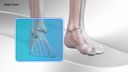 Toe Dislocation Repair with CPR™ Implant System