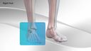 Foot Arthritis Repair with Compression Plate