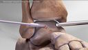 BioCartilage® Allograft Cartilage Repair in the Ankle