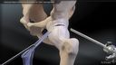 Femoral Neck Osteochondroplasty for Cam Impingement