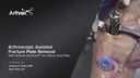 Arthroscopic Assisted Fracture Plate Removal With Arthrex® Quickset™ as a Bone Void Filler
