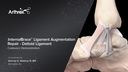 InternalBrace™ Ligament Augmentation Repair - Deltoid Ligament
