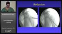 Proximal Humeral Fractures: Percutaneous Pinning (Presentation 2 of 4)