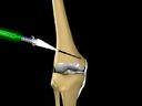 Femoral Opening Wedge Osteotomy Surgical Technique
