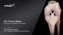 ACL Primary Repair with InternalBrace™ Ligament Augmentation
