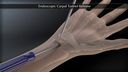 Endoscopic Carpal Tunnel Release