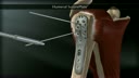 Humeral SuturePlate™