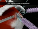 RC Repair - Suture Management