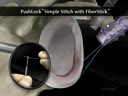 PushLock® Simple Stitch with FiberStick™