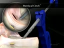 Meniscal Cinch™