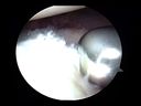 Arthroscopic Bankart with Posterior Plication