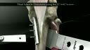 Tibial Tubercle Osteotomy using the T3 AMZ System