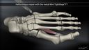 Hallux Valgus Repair with the Metal Mini TightRope® FT