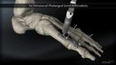 1st Metatarsal Phalangeal Joint Arthrodesis