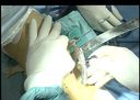 Proximal Tibial Opening Wedge Osteotomy