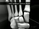 Mini TightRope® Lisfranc Repair