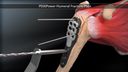 PEEKPower Humeral Fracture Plate