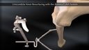 Unicondylar Knee Resurfacing with the iBalance® UKA System