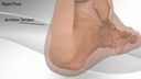 Achilles Tendon Repair with SpeedBridge™ System