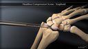 Headless Compression Screw – Scaphoid