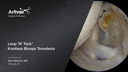 Loop 'N' Tack™ Knotless Biceps Tenodesis