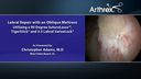 Labral Repair with an Oblique Mattress Utilizing a 90 Degree SutureLasso™, TigerStick® and 3.5 Labral SwiveLock®