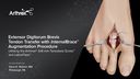 Extensor Digitorum Brevis (EDB) Tendon Transfer with InternalBrace™ Augmentation Utilizing the Arthrex® 3x8 mm Tenodesis Screw™ and LabralTape™